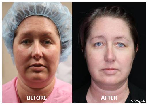 Kim Before and After 8 Weeks Kim Before and After 8 Weeks