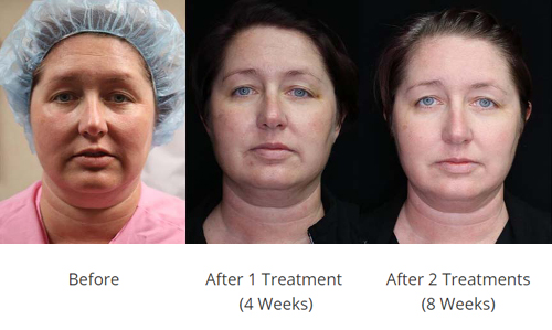 Full Face and Neck Full Face and Neck