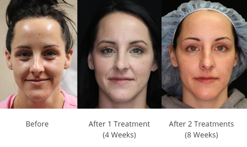 Katie Frontal Before 4 Weeks and 8 Weeks Katie Frontal Before 4 Weeks and 8 Weeks